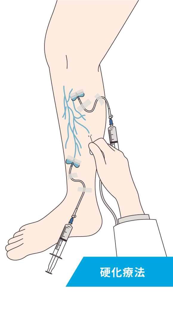 硬化療法